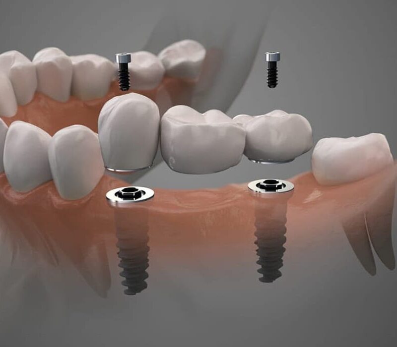 Como-Funciona-o-Tratamento-de-Implante-Protese-Fixa-Tipo-Protocolo