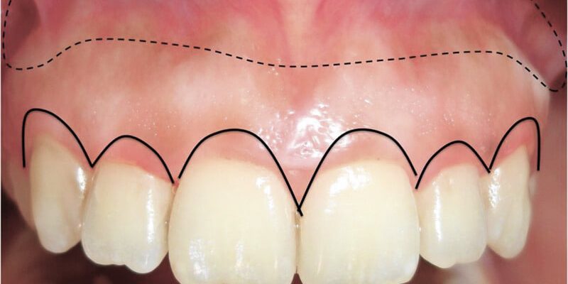 cirurgia-gengival-aumento-de-coroa-clinica-800x400